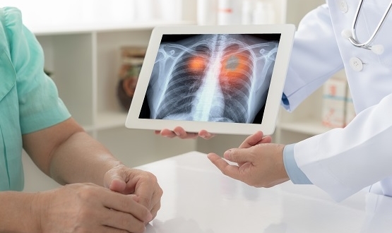 Lung cancer screening pilot yields promising results in Kent & Medway   