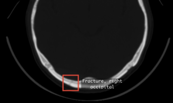 Neurocritical AI solution to be deployed into A&E At MKUH